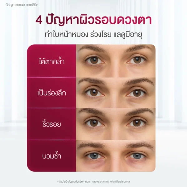 ปัญหาผิวรอบดวงตา