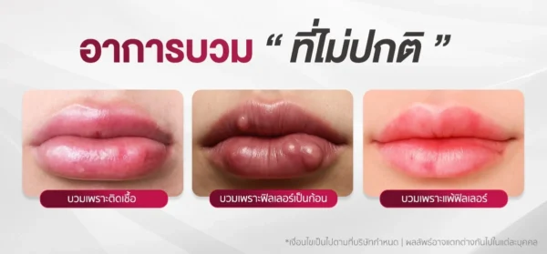 อาการบวมฟิลเลอร์ที่ผิดปกติ