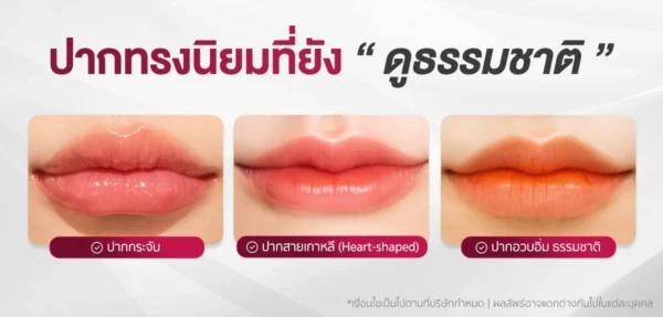รูปทรงริมฝีปากยอดนิยมในการฉีดฟิลเลอร์