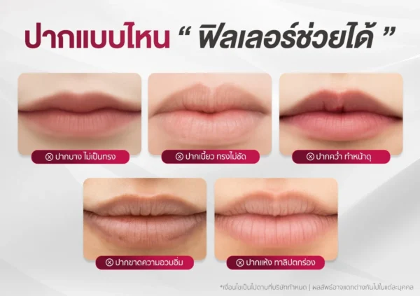 ปัญหาริมฝีปาก
