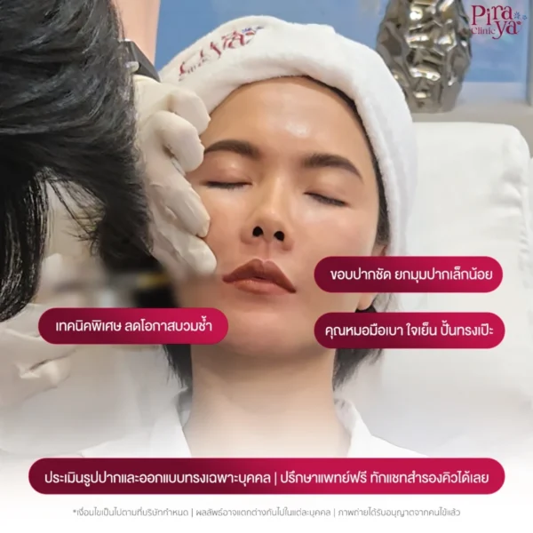 ฉีดฟิลเลอร์ปาก