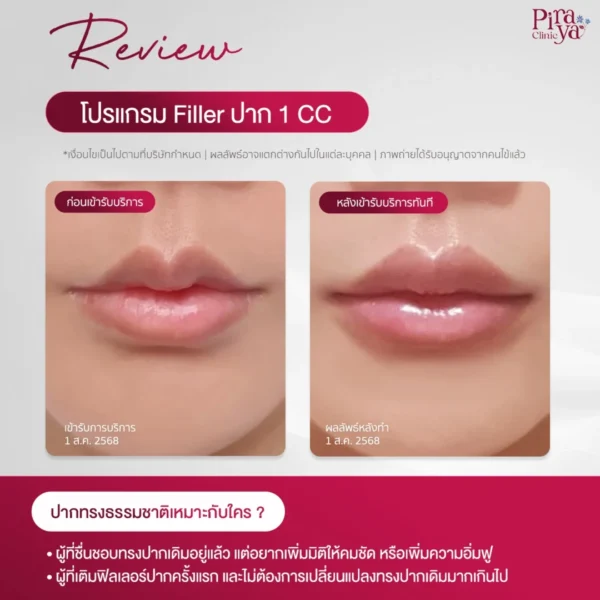 รีวิวฟิลเลอร์ปาก