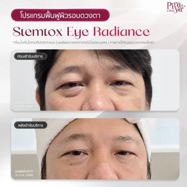รีวิวโปรแกรม Stemtox Eye Radiance ลดใต้ตาคล้ำ ถุงใต้ตา ตาแพนด้า