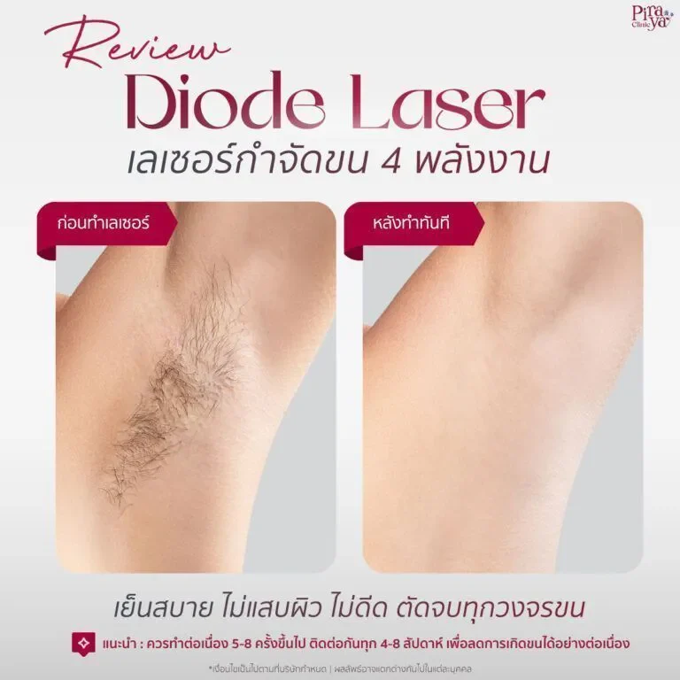 piraya clinic, ภิรญา คลินิก, คลิกนิกความงาม, คลินิก, ทำหน้า, หัตถการ, เมืองทอง, Diode Laser, ไดโอด
