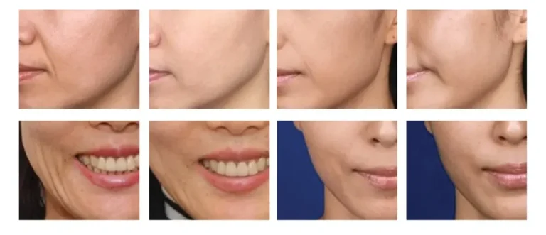 piraya clinic, ภิรญา คลินิก, คลิกนิกความงาม, คลินิก, ทำหน้า, หัตถการ, เมืองทอง, Dermashine Pro