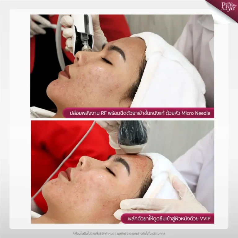 ขั้นตอนการทำ Hydro Deluxe, Piraya Clinic, ภิรญา คลินิก, คลิกนิกความงาม, คลินิก, ทำหน้า, หัตถการ, เมืองทอง