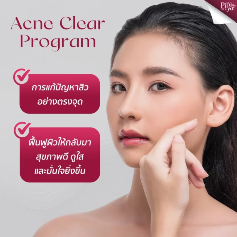 โปรแกรมรักษาสิวครบวงจร 4 ขั้นตอน แก้ไขปัญหาสิวตรงจุด ฟื้นฟูผิวให้สุขภาพดี
