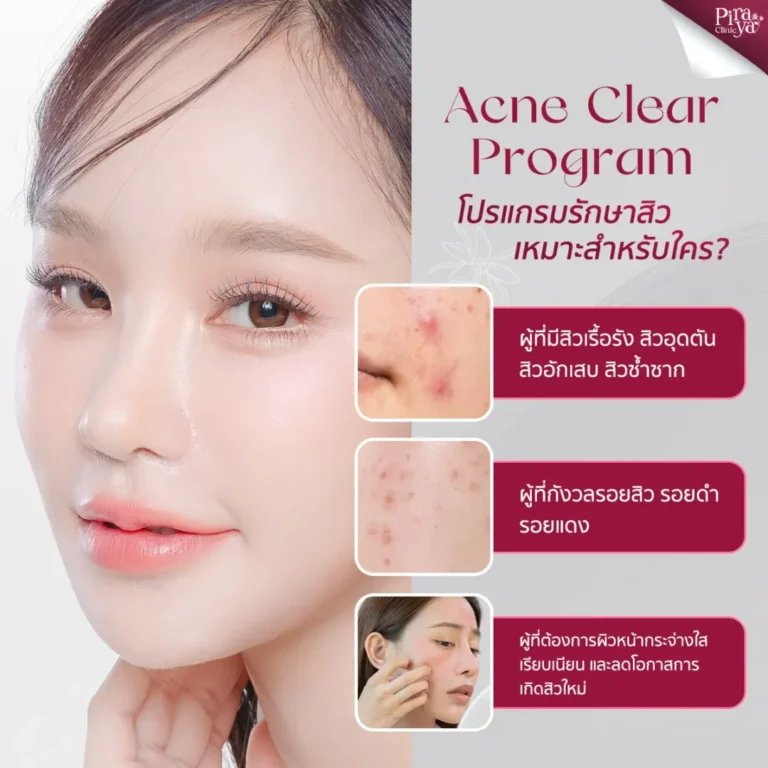 โปรแกรมรักษาสิวครบวงจร 4 ขั้นตอนเหมาะกับใคร