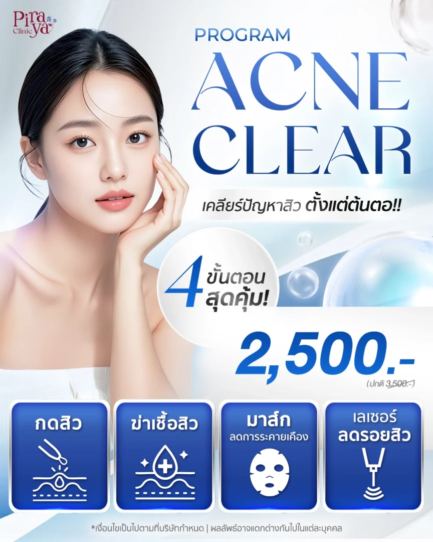 โปรโมชันรักษาสิว acne clear promotion