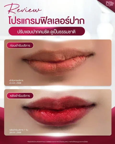 รีวิว Before – After (1 CC บริเวณปาก)