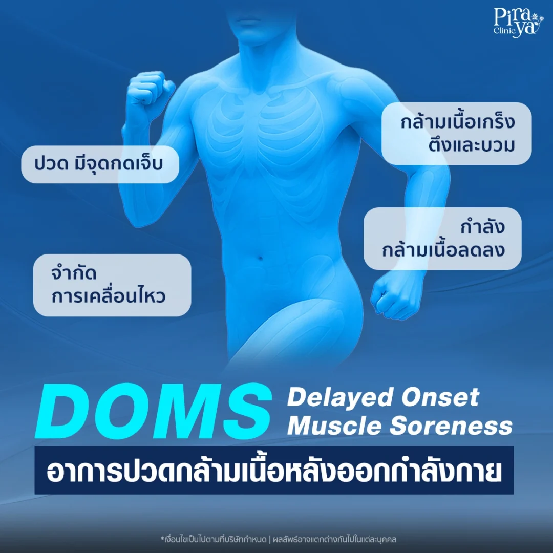 อาการปวดกล้ามเนื้อหลังจากออกกำลังกาย หรือ Delayed Onset Muscle Soreness (DOMS)